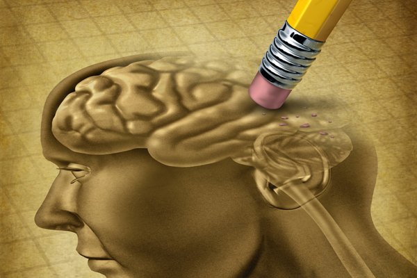 Zeichnung von Gehirn mit Demenz